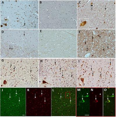 Extensive Anti-CoA Immunostaining in Alzheimer’s Disease and Covalent Modification of Tau by a Key Cellular Metabolite Coenzyme A
